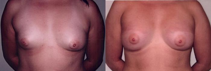 Before & After Breast Augmentation Case 35 View #2 View in Mississauga & Toronto, ON
