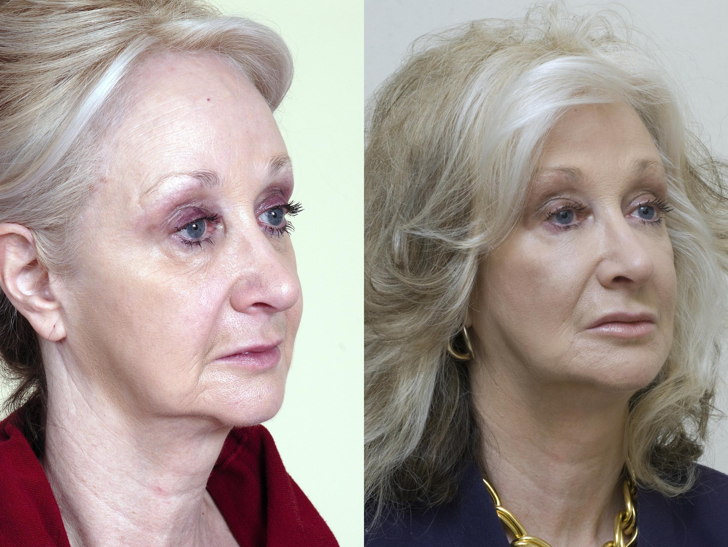 Injectable Fillers Before And After Pictures Case 39 Mississauga And Toronto On Mississauga 
