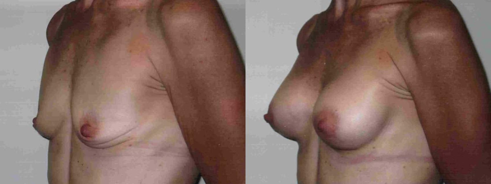 Before & After Breast Augmentation Case 4 View #1 View in Mississauga & Toronto, ON