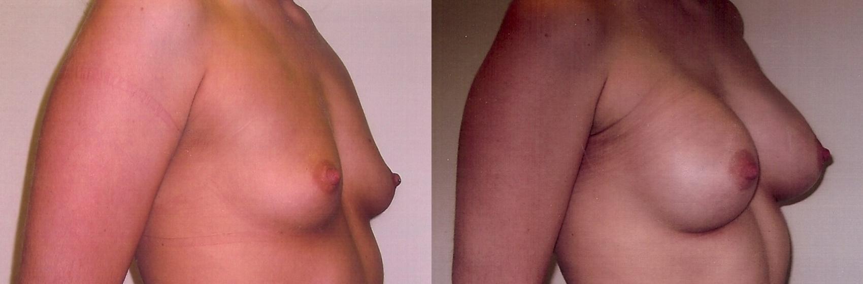 Before & After Breast Augmentation Case 46 View #1 View in Mississauga & Toronto, ON