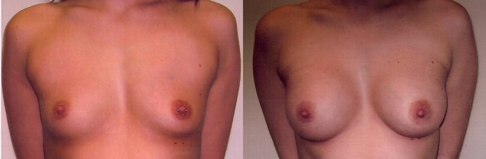 Before & After Breast Augmentation Case 46 View #2 View in Mississauga & Toronto, ON
