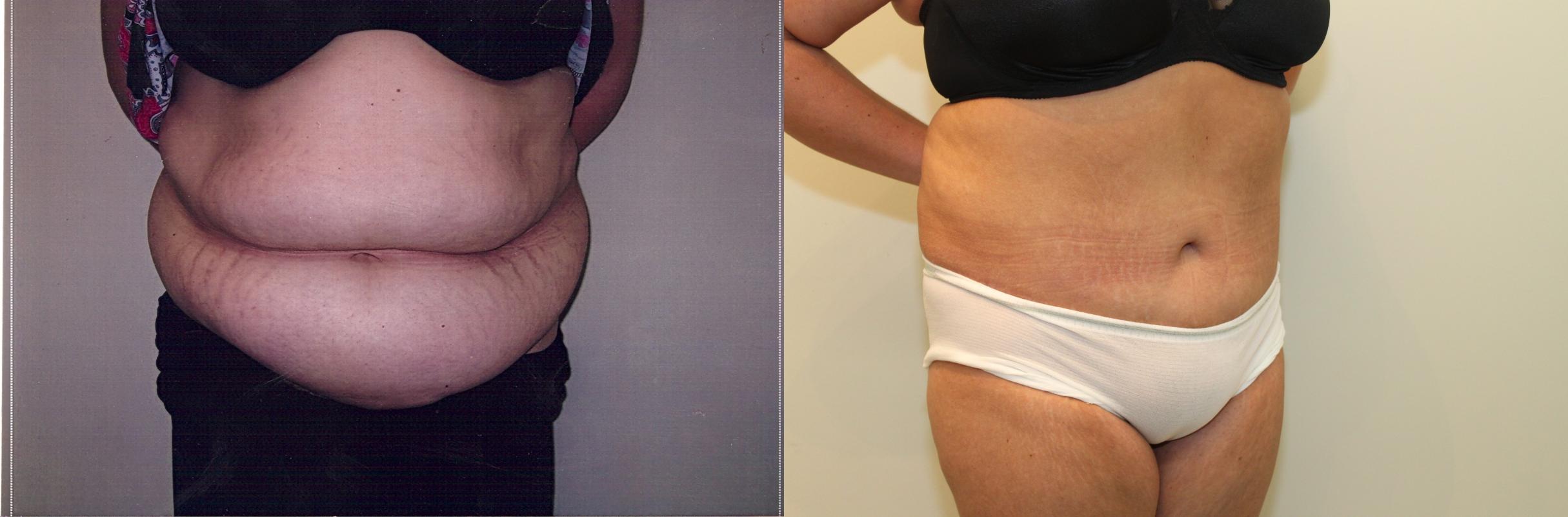 Before & After Massive Weight Loss Case 53 View #1 View in Mississauga & Toronto, ON