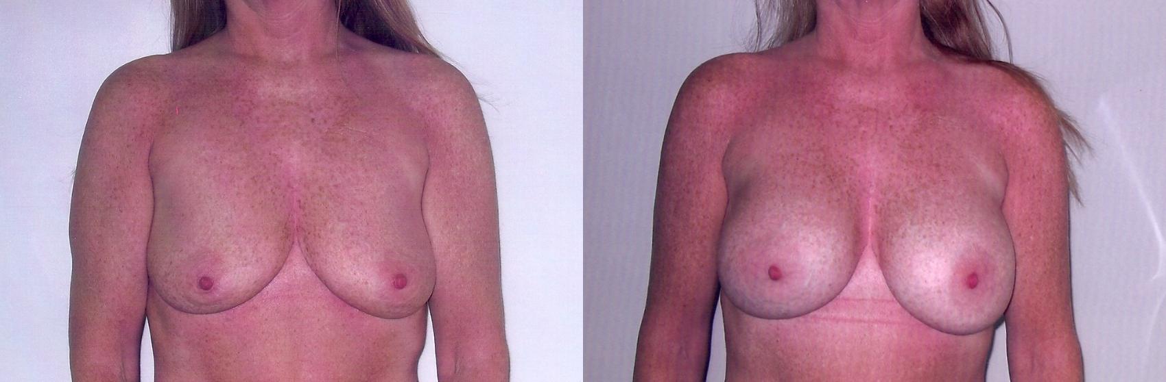 Before & After Breast Augmentation Case 57 View #1 View in Mississauga & Toronto, ON