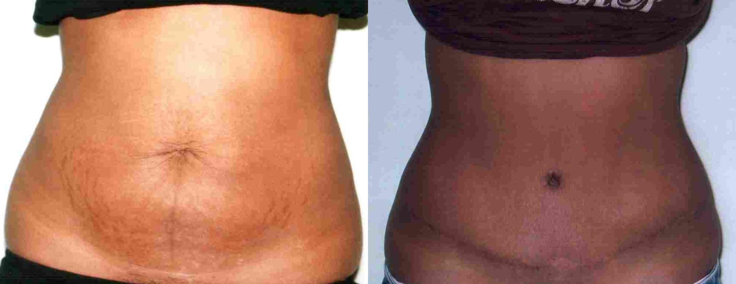 Before & After Tummy Tuck Case 61 View #1 View in Mississauga & Toronto, ON