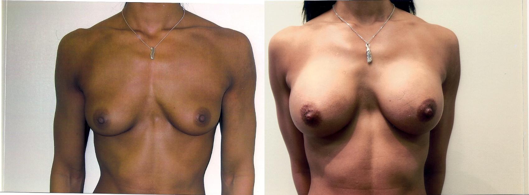 Before & After Breast Augmentation Case 63 View #1 View in Mississauga & Toronto, ON