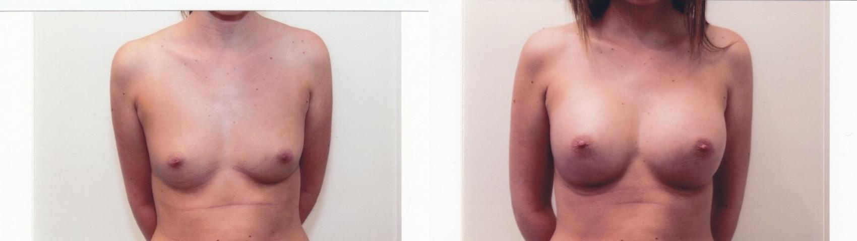Before & After Breast Augmentation Case 64 View #1 View in Mississauga & Toronto, ON