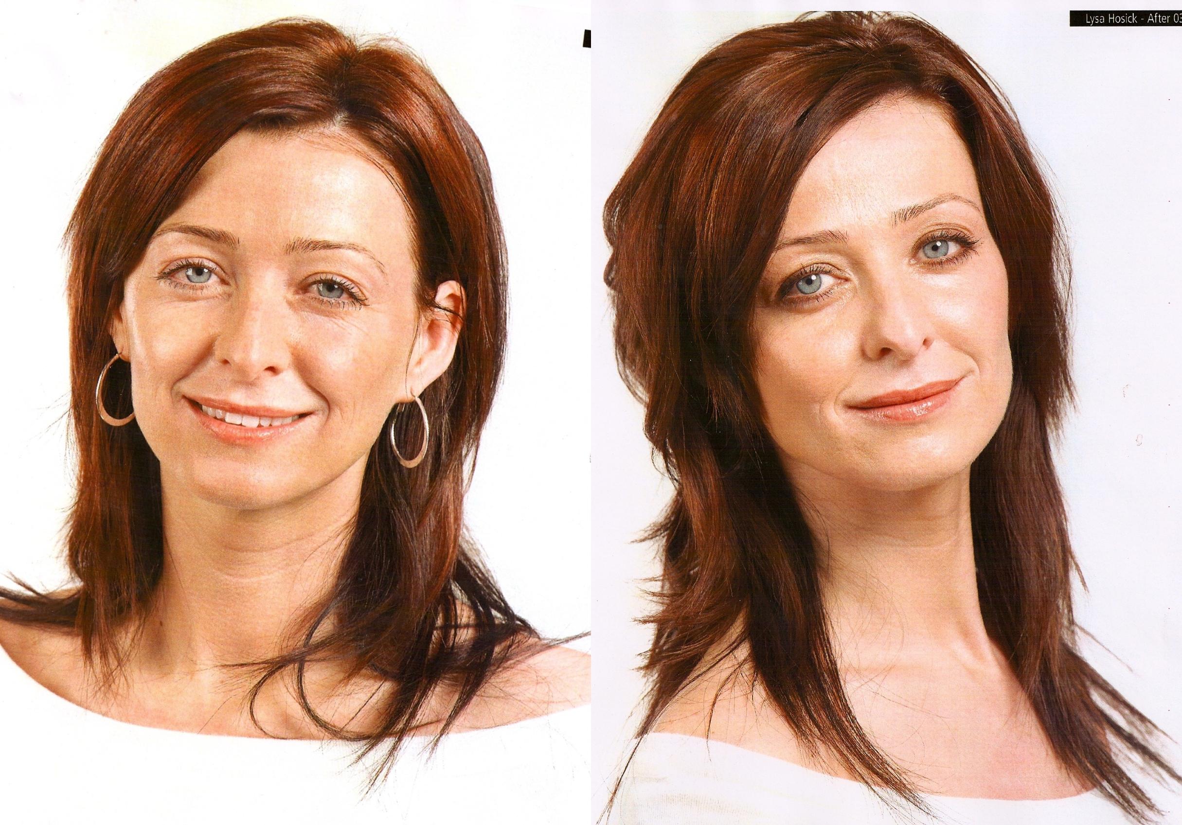 Before & After Injectable Fillers Case 66 View #1 View in Mississauga & Toronto, ON