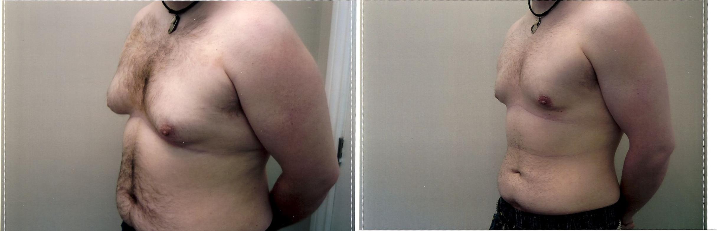 Before & After Liposuction Case 68 View #3 View in Mississauga & Toronto, ON