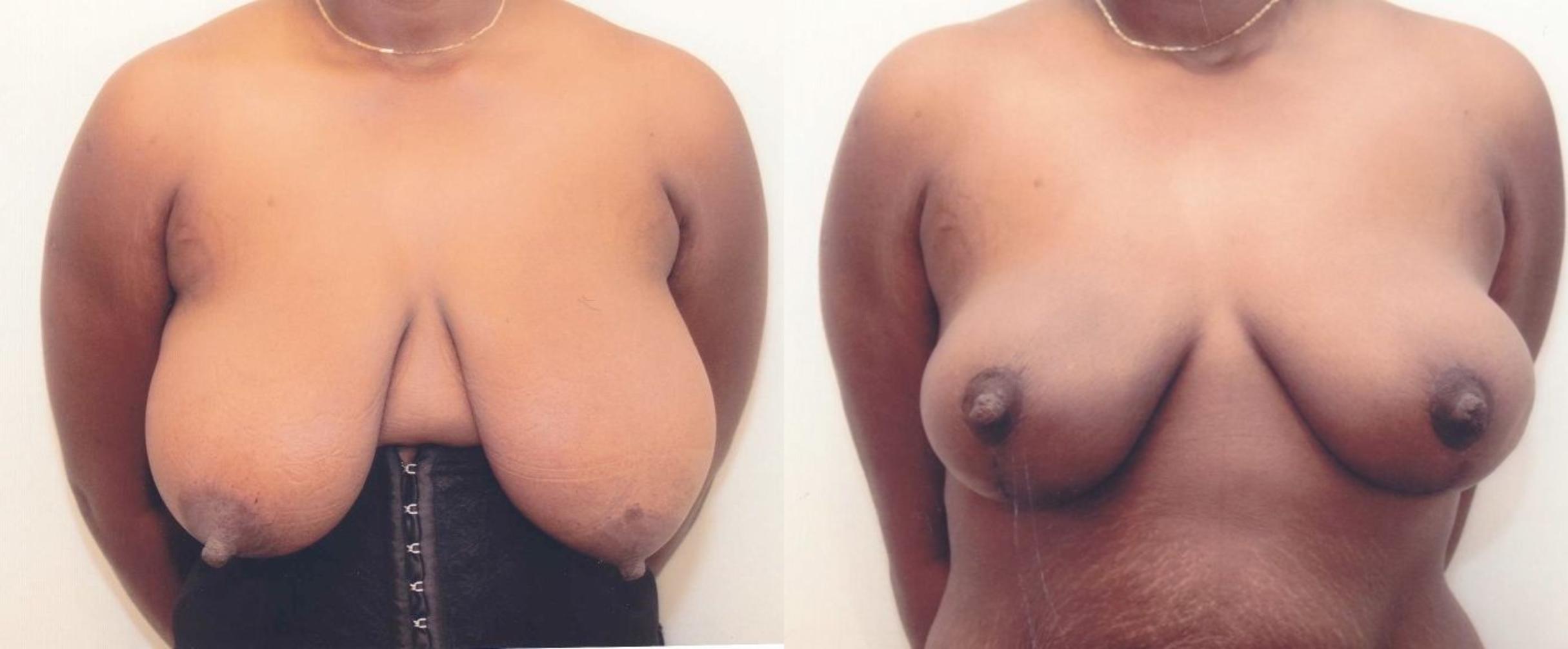 Before & After Breast Reduction Case 69 View #1 View in Mississauga & Toronto, ON
