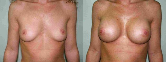 Before & After Breast Augmentation Case 7 View #1 View in Mississauga & Toronto, ON