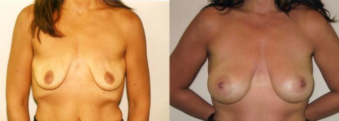 Before & After Breast Augmentation Case 72 View #1 View in Mississauga & Toronto, ON
