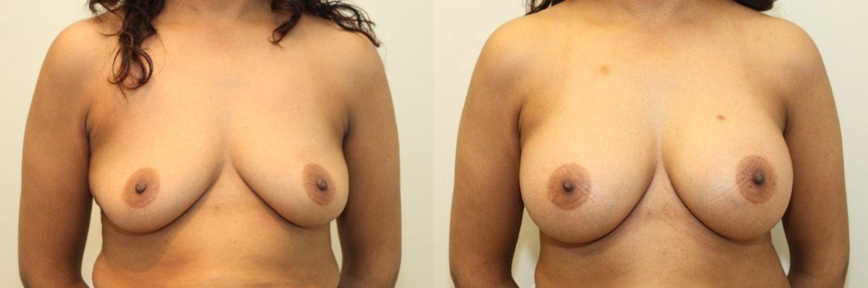 Before & After Breast Augmentation Case 75 View #1 View in Mississauga & Toronto, ON