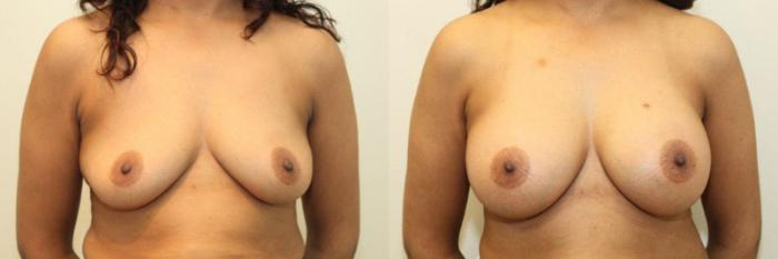 Before & After Breast Augmentation Case 75 View #1 View in Mississauga & Toronto, ON