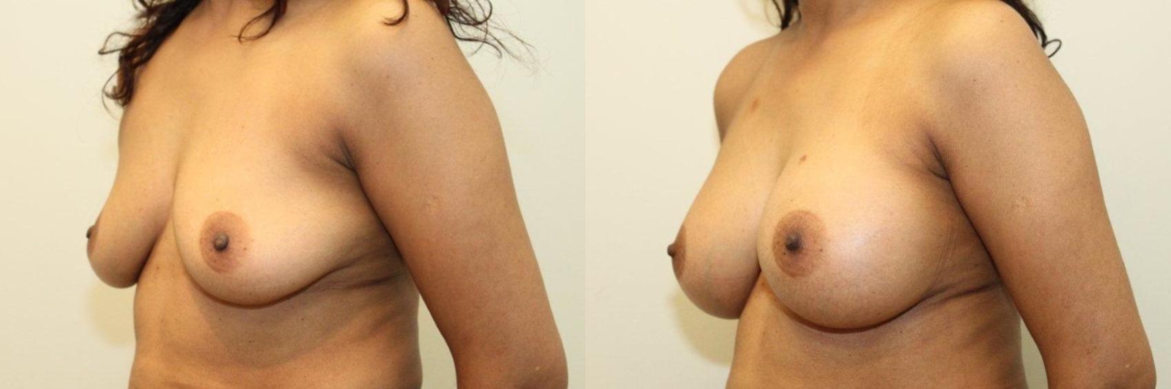 Before & After Breast Augmentation Case 75 View #2 View in Mississauga & Toronto, ON