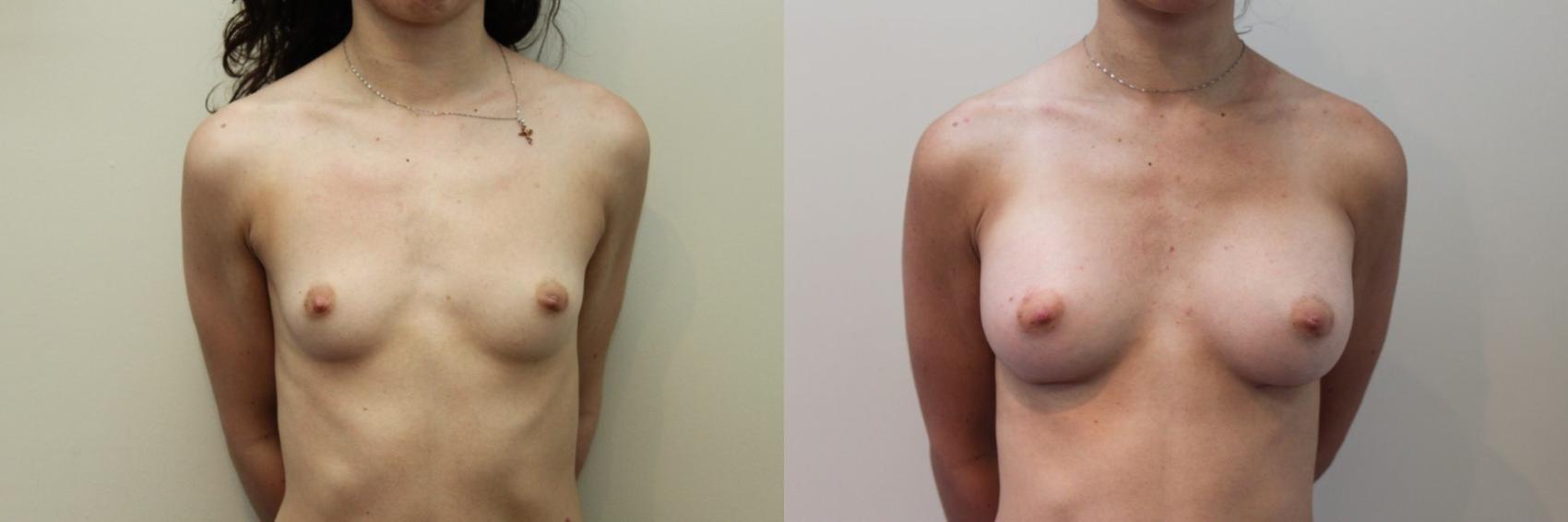 Before & After Breast Augmentation Case 81 View #1 View in Mississauga & Toronto, ON