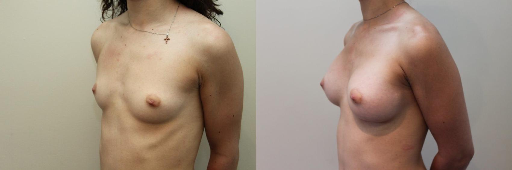 Before & After Breast Augmentation Case 81 View #2 View in Mississauga & Toronto, ON