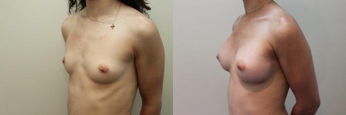 Before & After Breast Augmentation Case 81 View #2 View in Mississauga & Toronto, ON