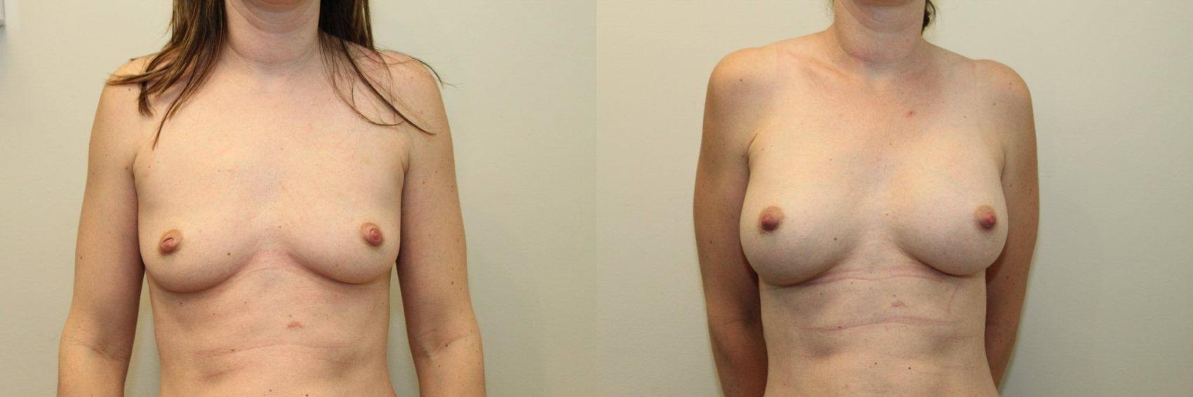 Before & After Breast Augmentation Case 86 View #1 View in Mississauga & Toronto, ON