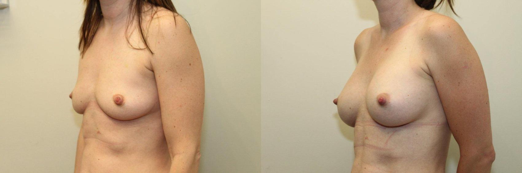 Before & After Breast Augmentation Case 86 View #2 View in Mississauga & Toronto, ON