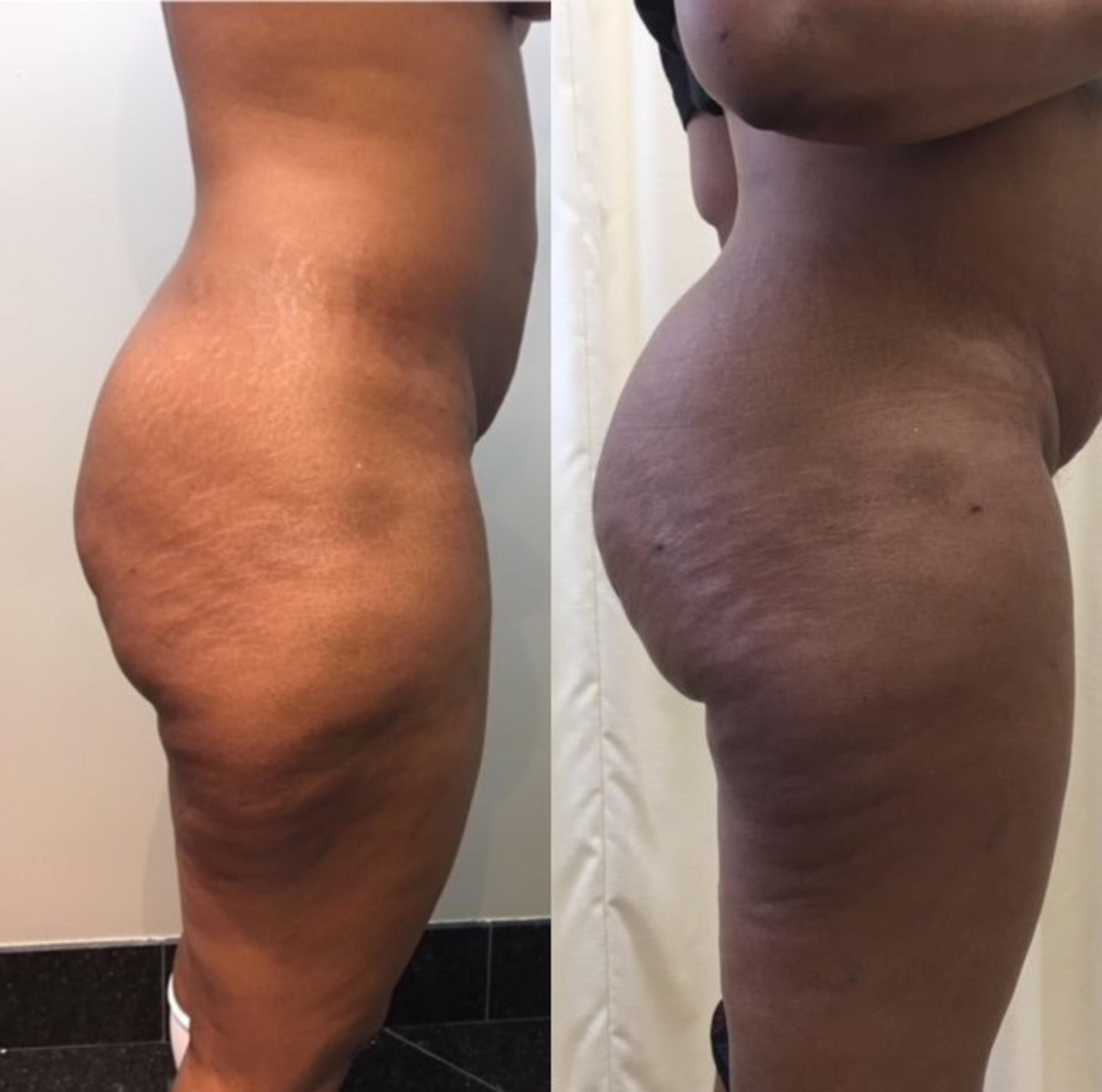 Before & After Liposuction Case 98 View #1 View in Mississauga & Toronto, ON