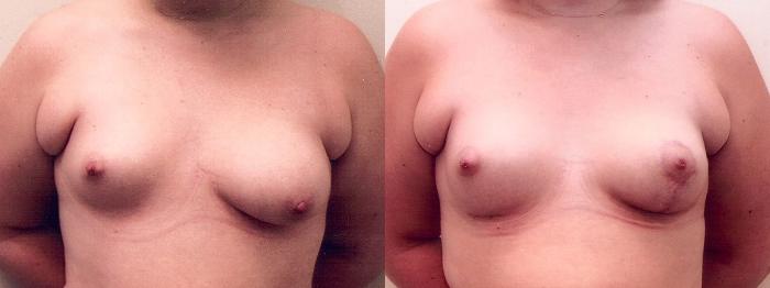 Before & After Breast Augmentation Revision Case 18 View #1 View in Mississauga & Toronto, ON