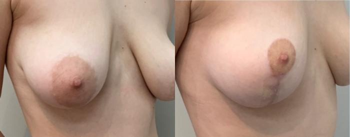 Before & After Breast Lift Case 120 Right Oblique View in Mississauga & Toronto, ON