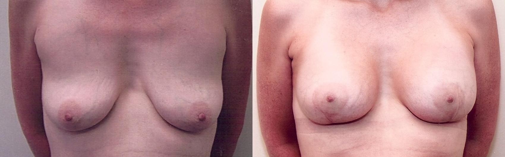 Before & After Breast Lift Case 25 View #1 View in Mississauga & Toronto, ON