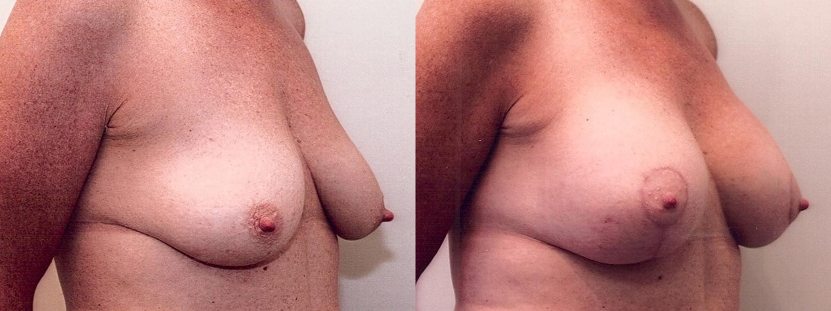 Before & After Breast Lift Case 6 View #2 View in Mississauga & Toronto, ON