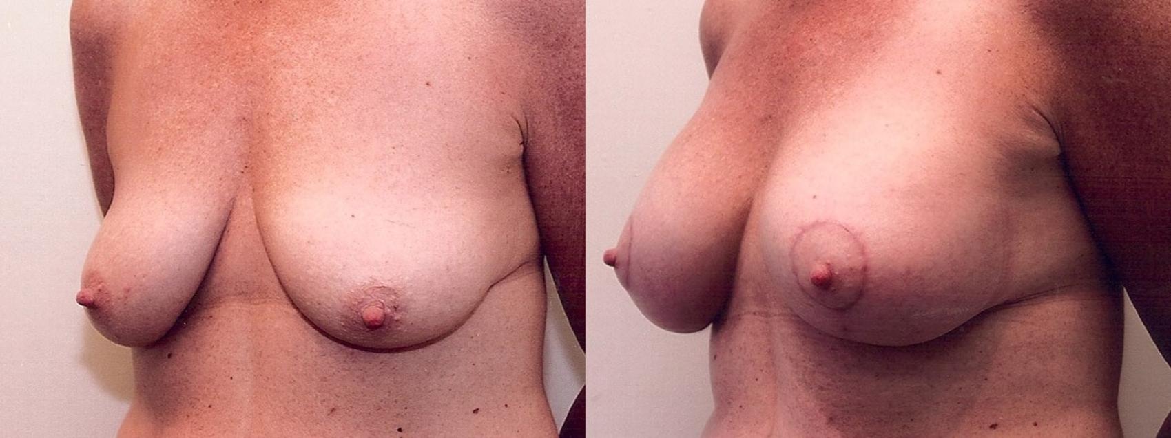 Before & After Breast Lift Case 6 View #3 View in Mississauga & Toronto, ON