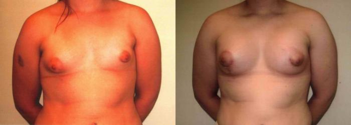 Before & After Breast Lift Case 62 View #1 View in Mississauga & Toronto, ON