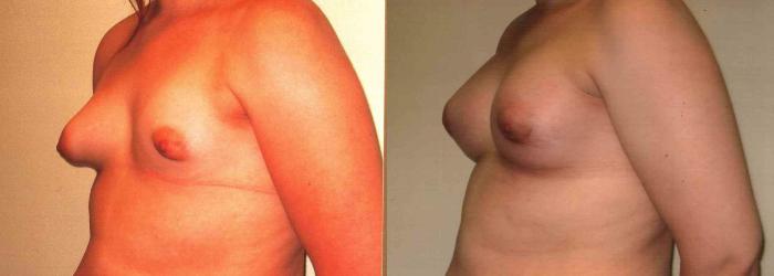 Before & After Breast Lift Case 62 View #2 View in Mississauga & Toronto, ON