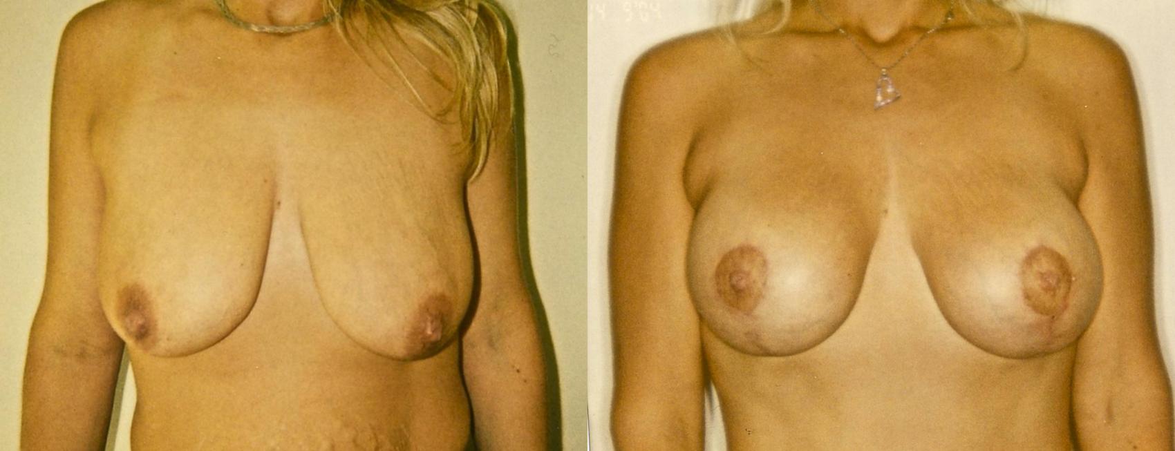 Before & After Breast Lift Case 70 View #1 View in Mississauga & Toronto, ON