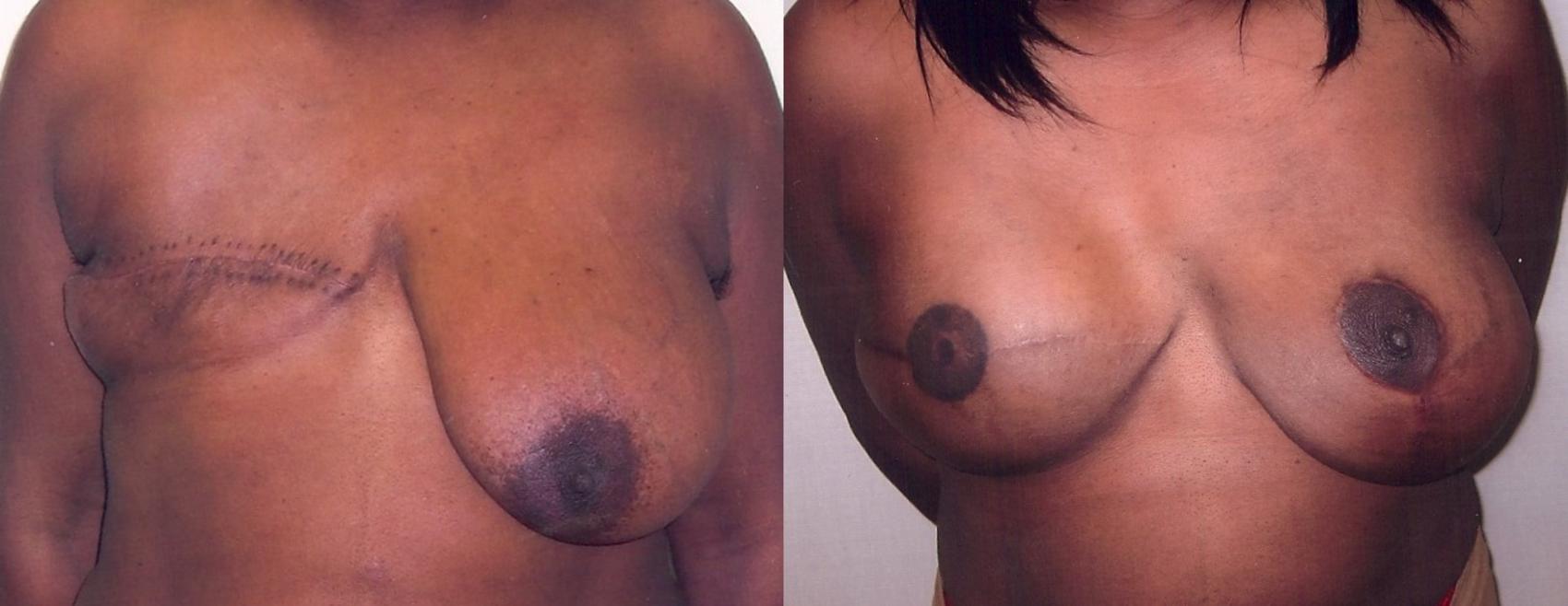 Before & After Breast Reconstruction Case 22 View #1 View in Mississauga & Toronto, ON