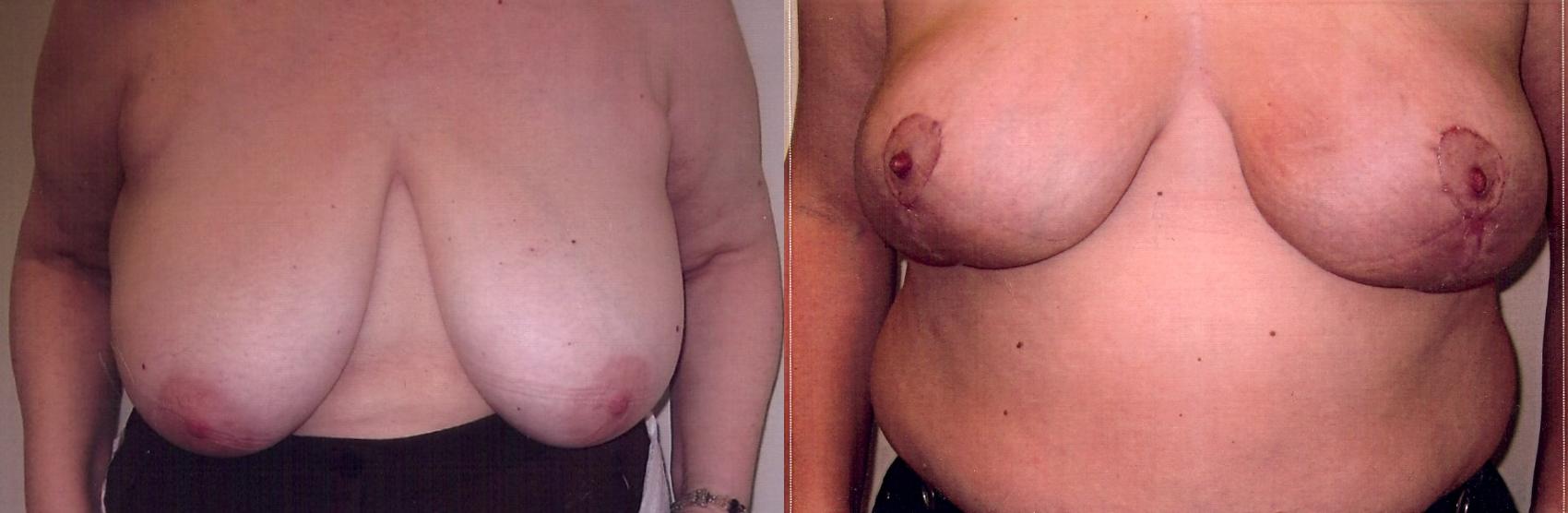 Before & After Breast Reduction Case 29 View #1 View in Mississauga & Toronto, ON
