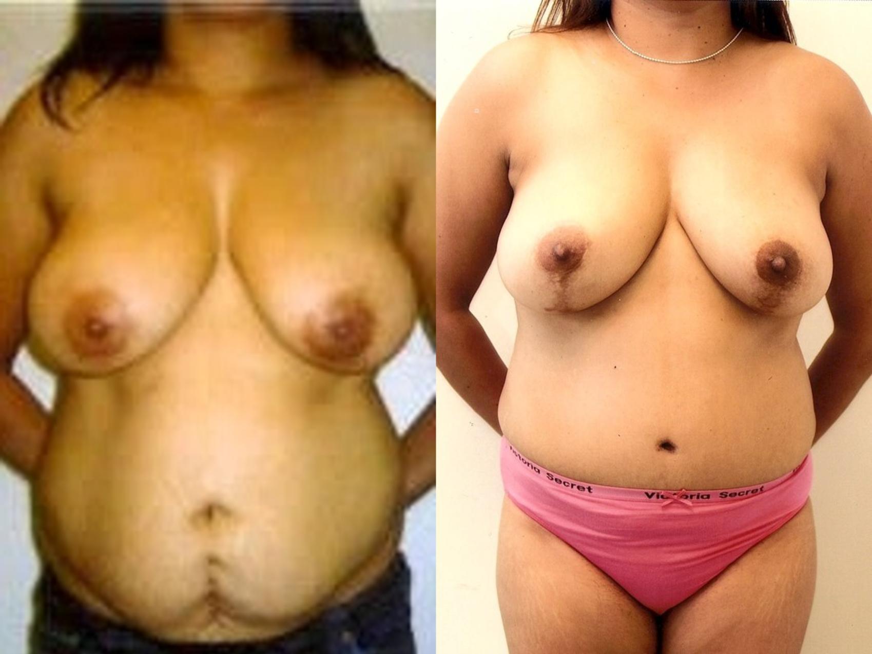 Before & After Breast Reduction Case 84 View #1 View in Mississauga & Toronto, ON