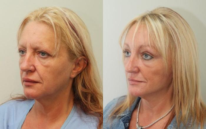 Before & After Facelift & Neck Lift Case 88 View #2 View in Mississauga & Toronto, ON