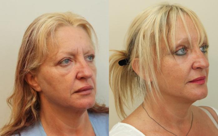 Before & After Facelift & Neck Lift Case 88 View #3 View in Mississauga & Toronto, ON