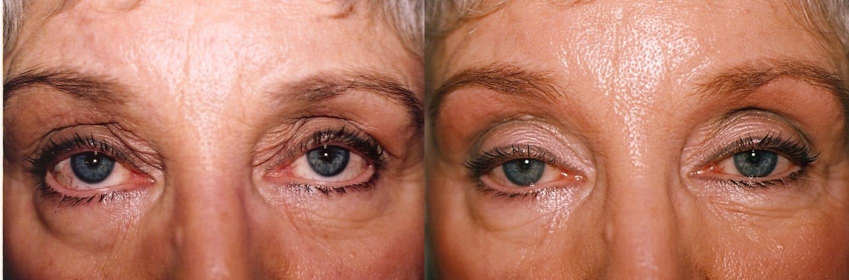 Before & After Eyelid Surgery Case 50 View #1 View in Mississauga & Toronto, ON