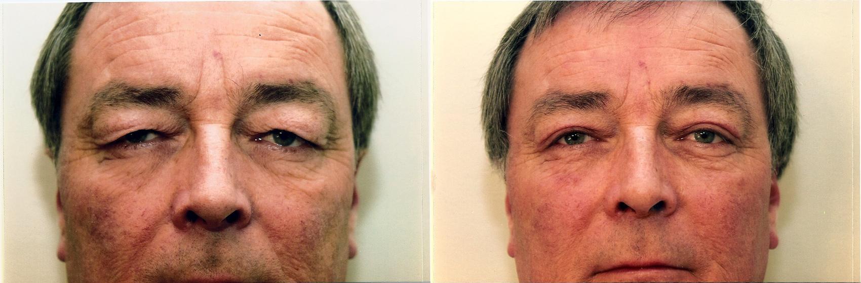 Before & After Eyelid Surgery Case 54 View #1 View in Mississauga & Toronto, ON
