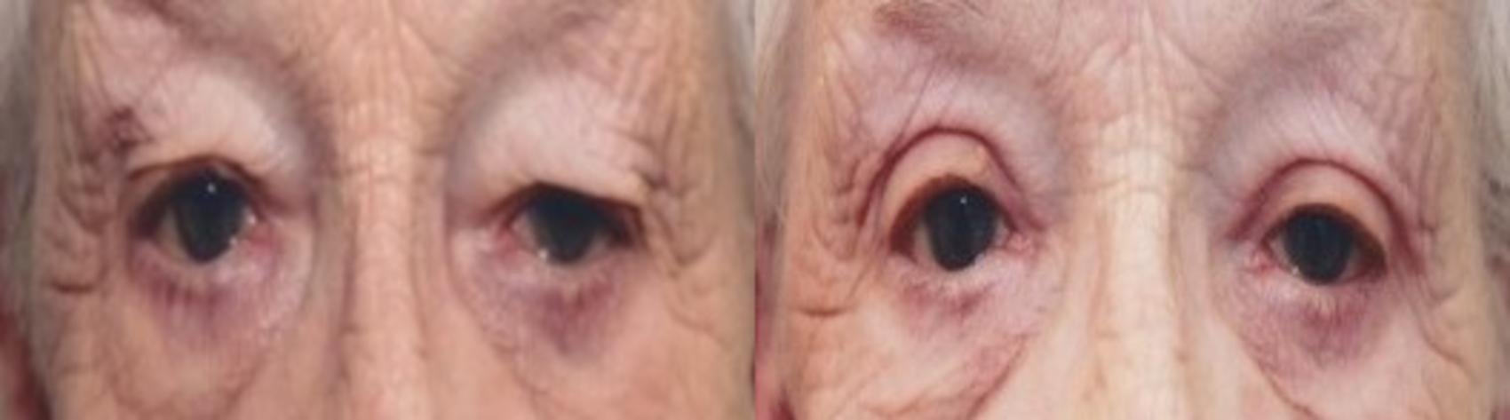 Before & After Eyelid Surgery Case 87 View #1 View in Mississauga & Toronto, ON
