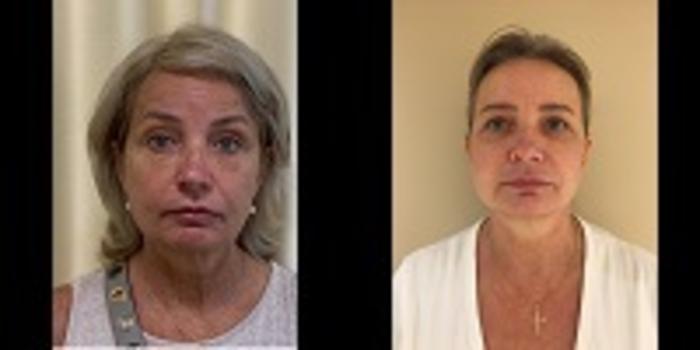Before & After Facelift & Neck Lift Case 101 View #1 View in Mississauga & Toronto, ON