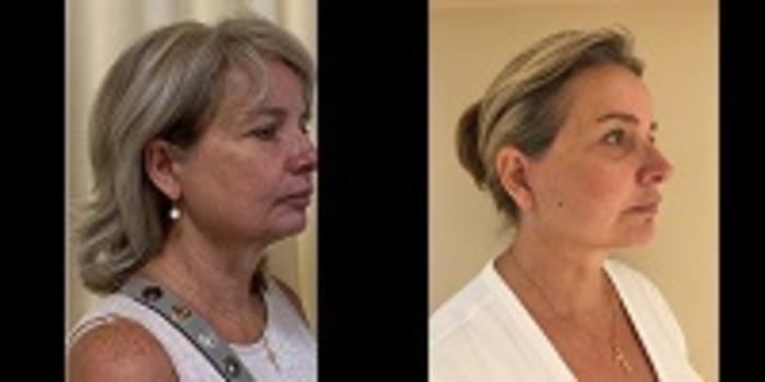 Before & After Facelift & Neck Lift Case 101 View #2 View in Mississauga & Toronto, ON