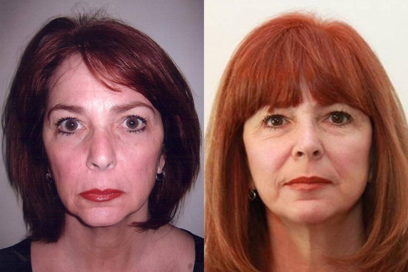 Before & After Facelift & Neck Lift Case 2 View #1 View in Mississauga & Toronto, ON