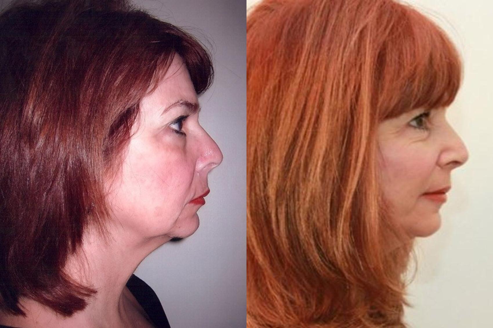 Before & After Facial Liposuction Case 2 View #2 View in Mississauga & Toronto, ON