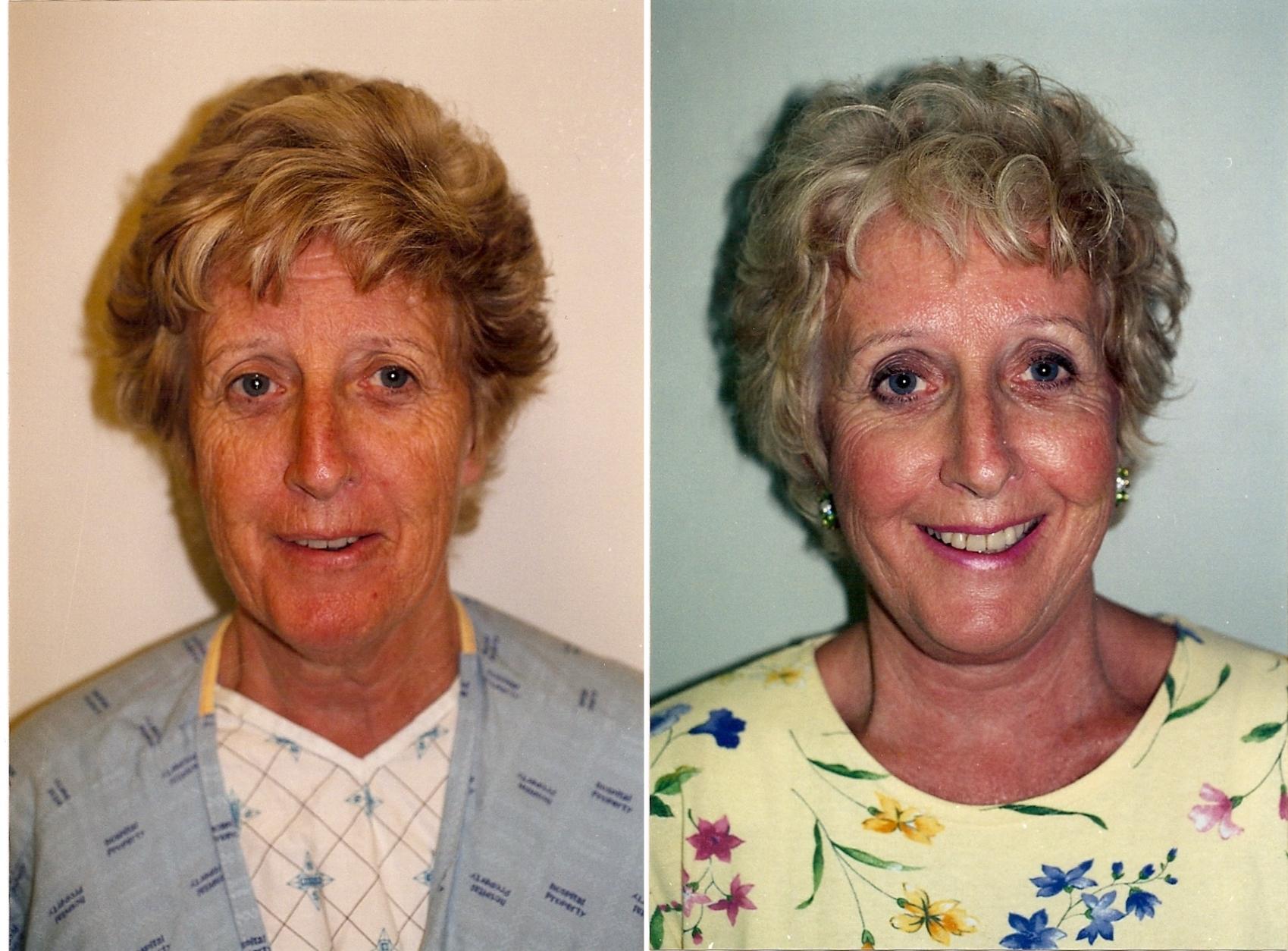 Before & After Facelift & Neck Lift Case 23 View #1 View in Mississauga & Toronto, ON
