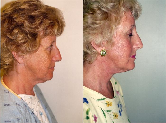 Before & After Facelift & Neck Lift Case 23 View #2 View in Mississauga & Toronto, ON