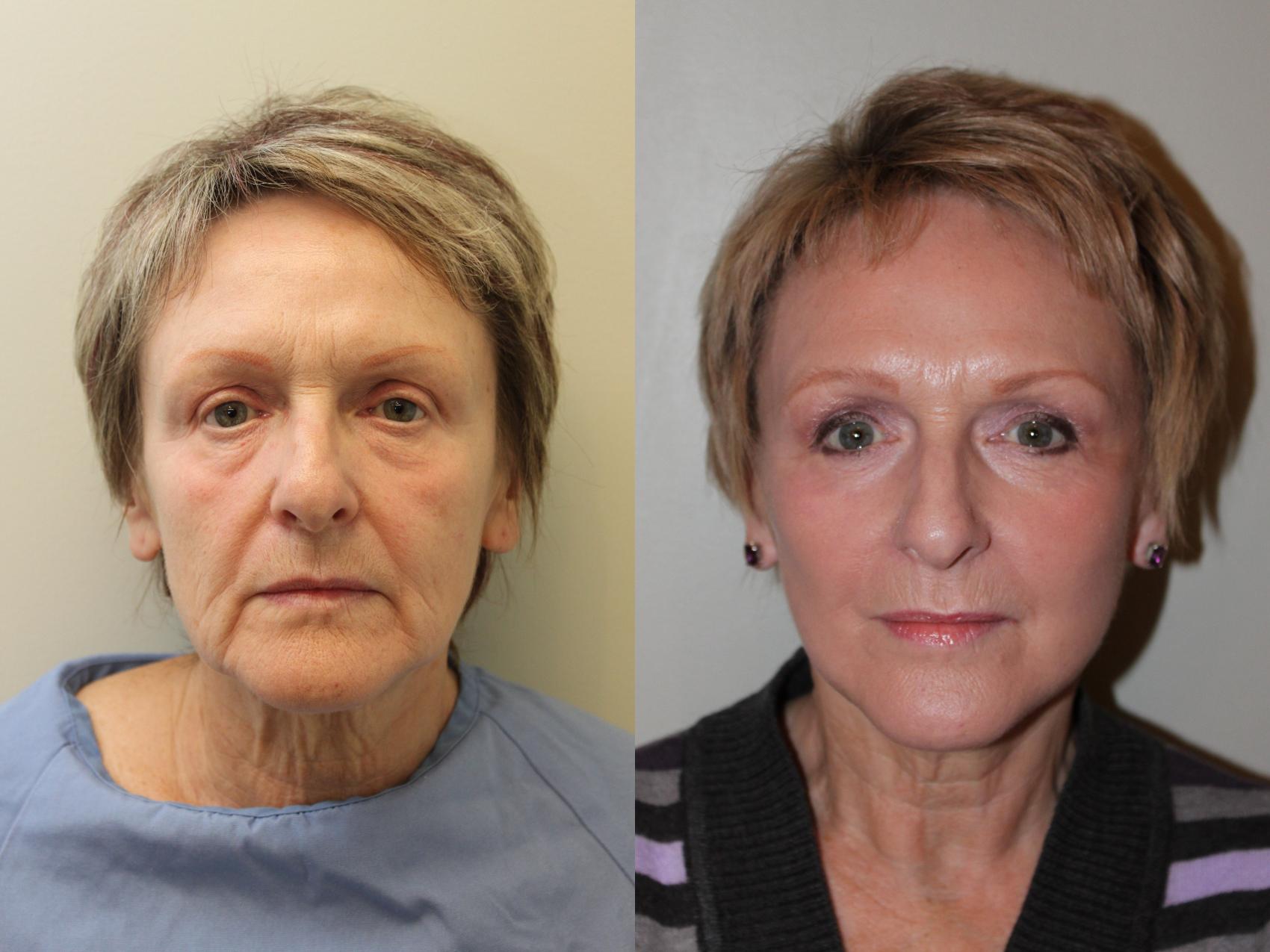Before & After Facelift & Neck Lift Case 48 View #1 View in Mississauga & Toronto, ON