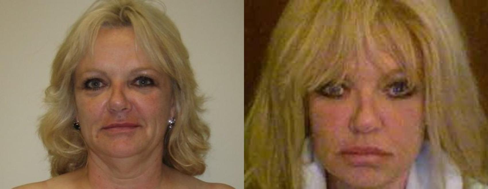 Before & After Facelift & Neck Lift Case 58 View #1 View in Mississauga & Toronto, ON