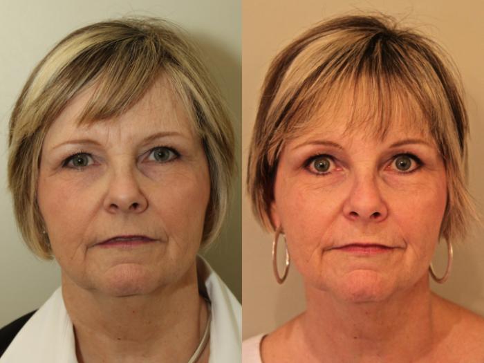 Before & After Facelift & Neck Lift Case 77 View #2 View in Mississauga & Toronto, ON