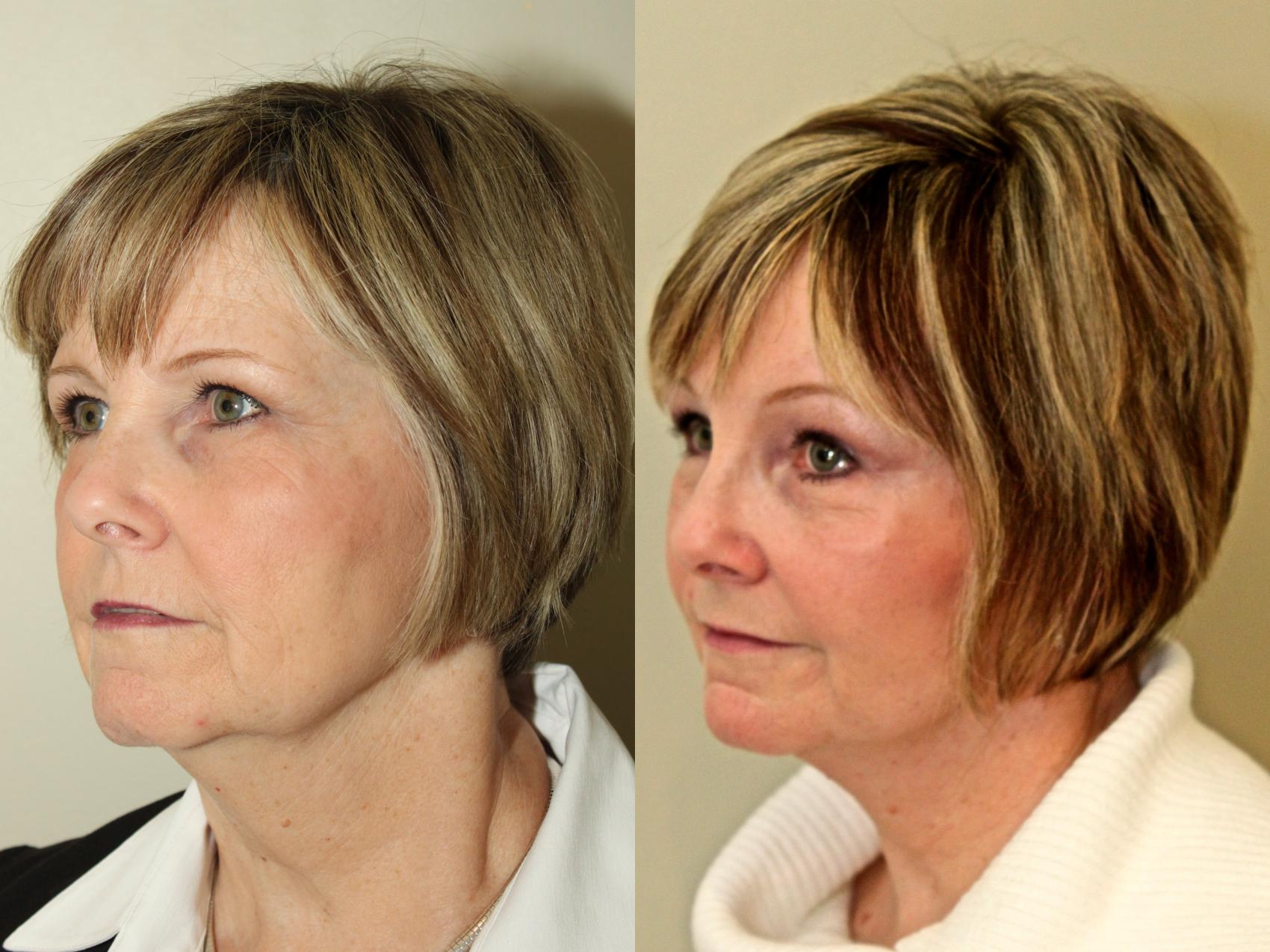 Facelift And Neck Lift Before And After Pictures Case 77 Mississauga And Toronto On Mississauga 